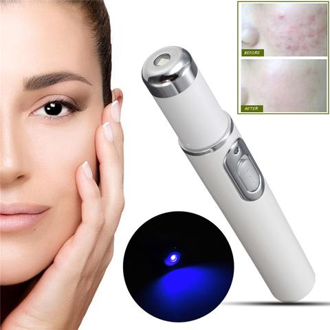 Laser treatment for acne scar removal