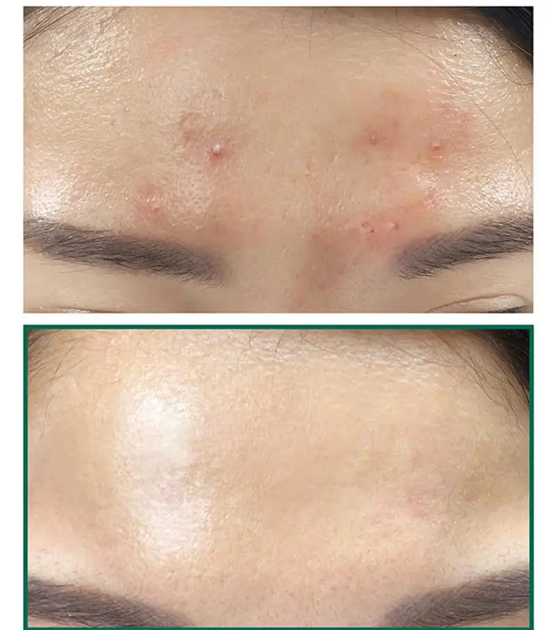 SOME BY MI AHA BHA PHA 30 Days Miracle Serum  Face Acne Treatment