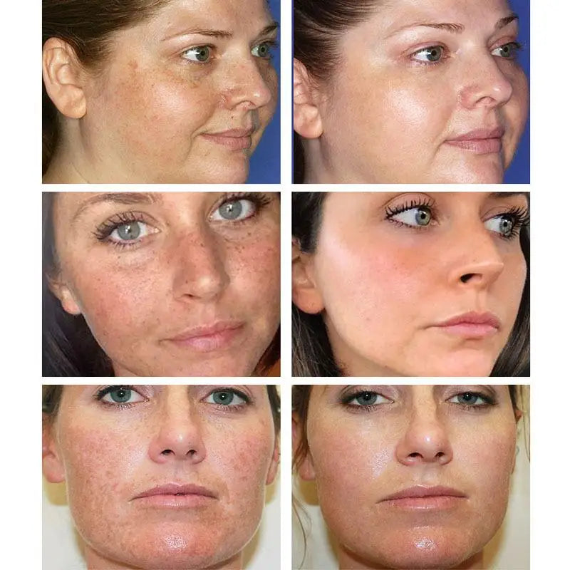 Whitening Freckles Cream Remove Melasma Dark Spots Lighten Melanin