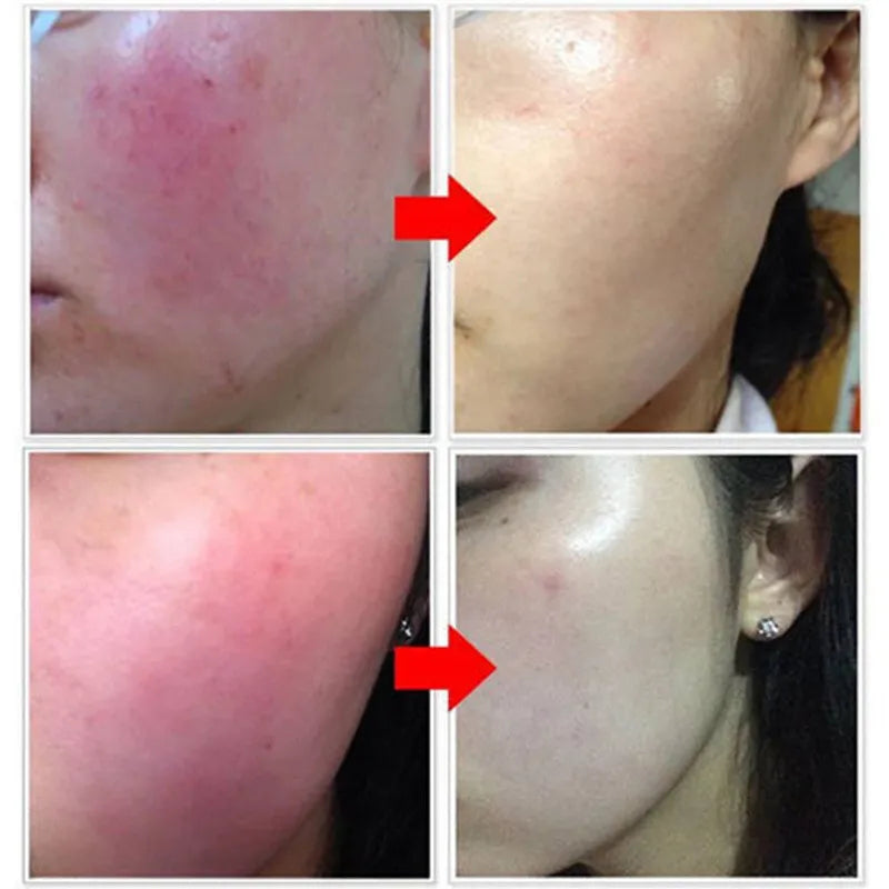 Rosacea cream soothes and repairs the skin in 7 days