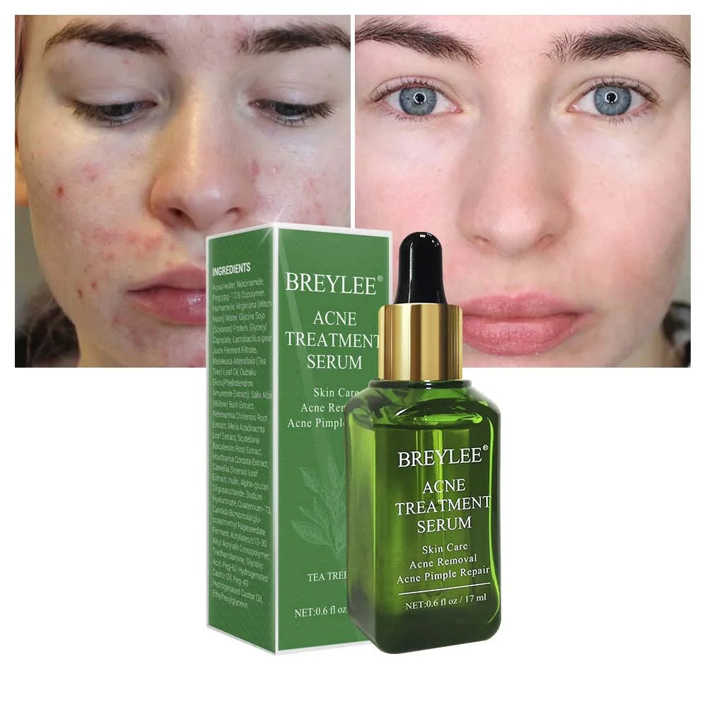 Acne Treatment Face Serum Anti Pimples Spots Scars Removal