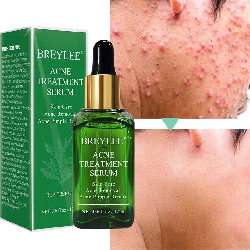 Acne Treatment Face Serum Anti Pimples Spots Scars Removal