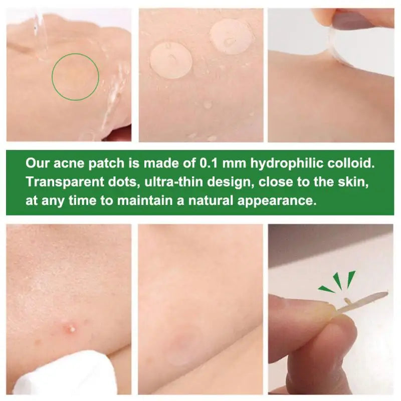 Acne Pimple Patch Sticker