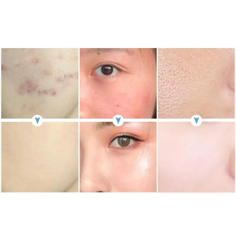 Oil Acne Spot Treatment Removing Anti Acne