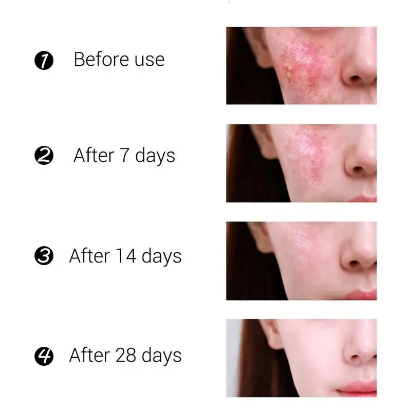 Oil Acne Spot Treatment Removing Anti Acne