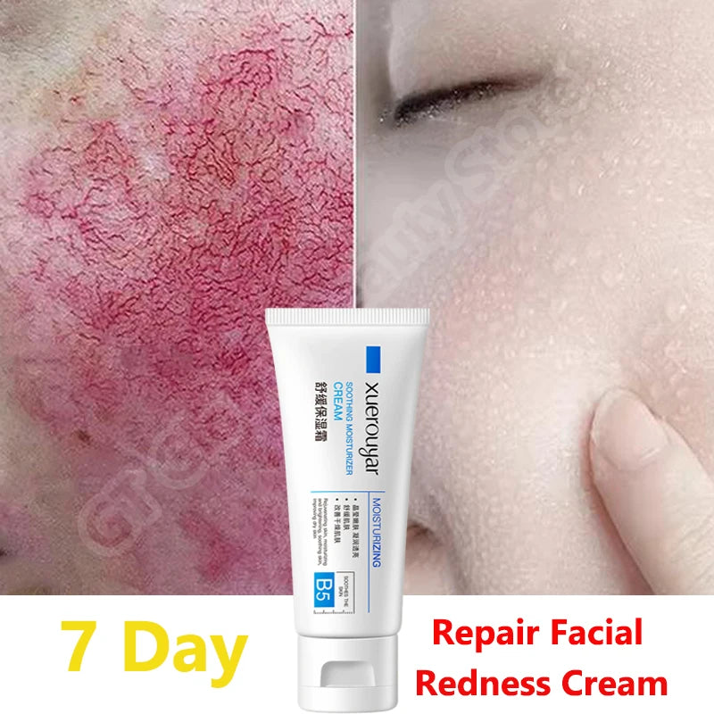 Rosacea cream soothes and repairs the skin in 7 days